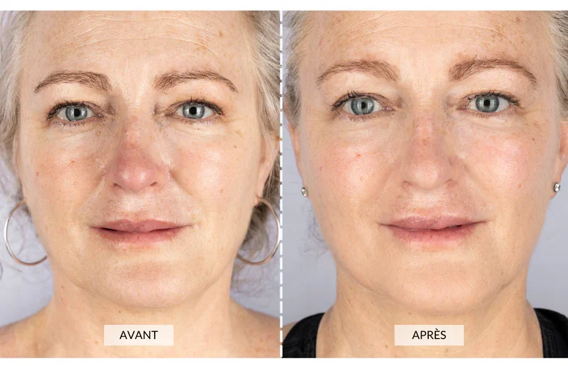 masque led avant après
