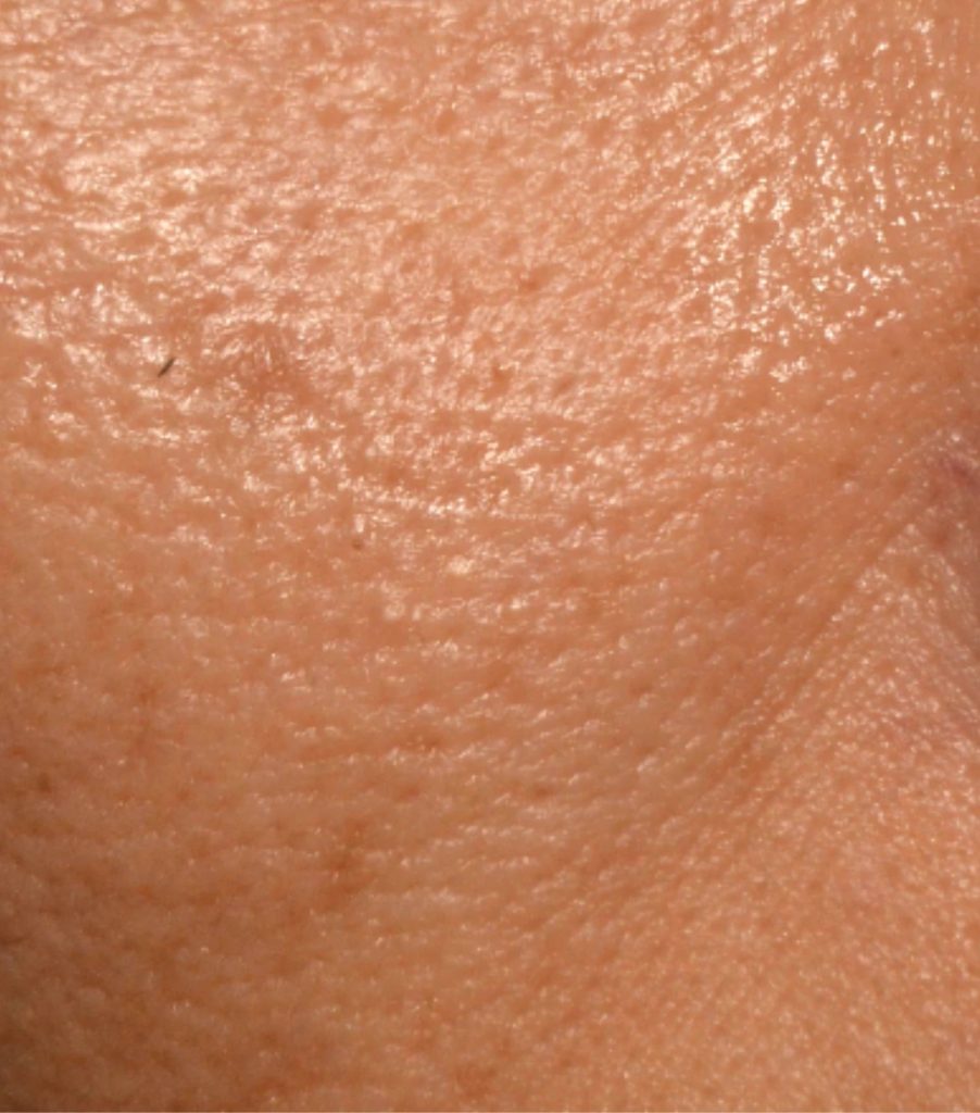 Masque led avant pores