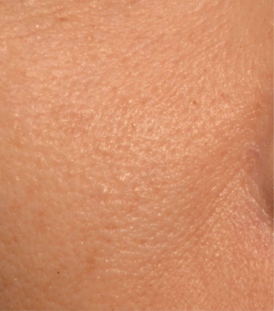 Masque led après pores