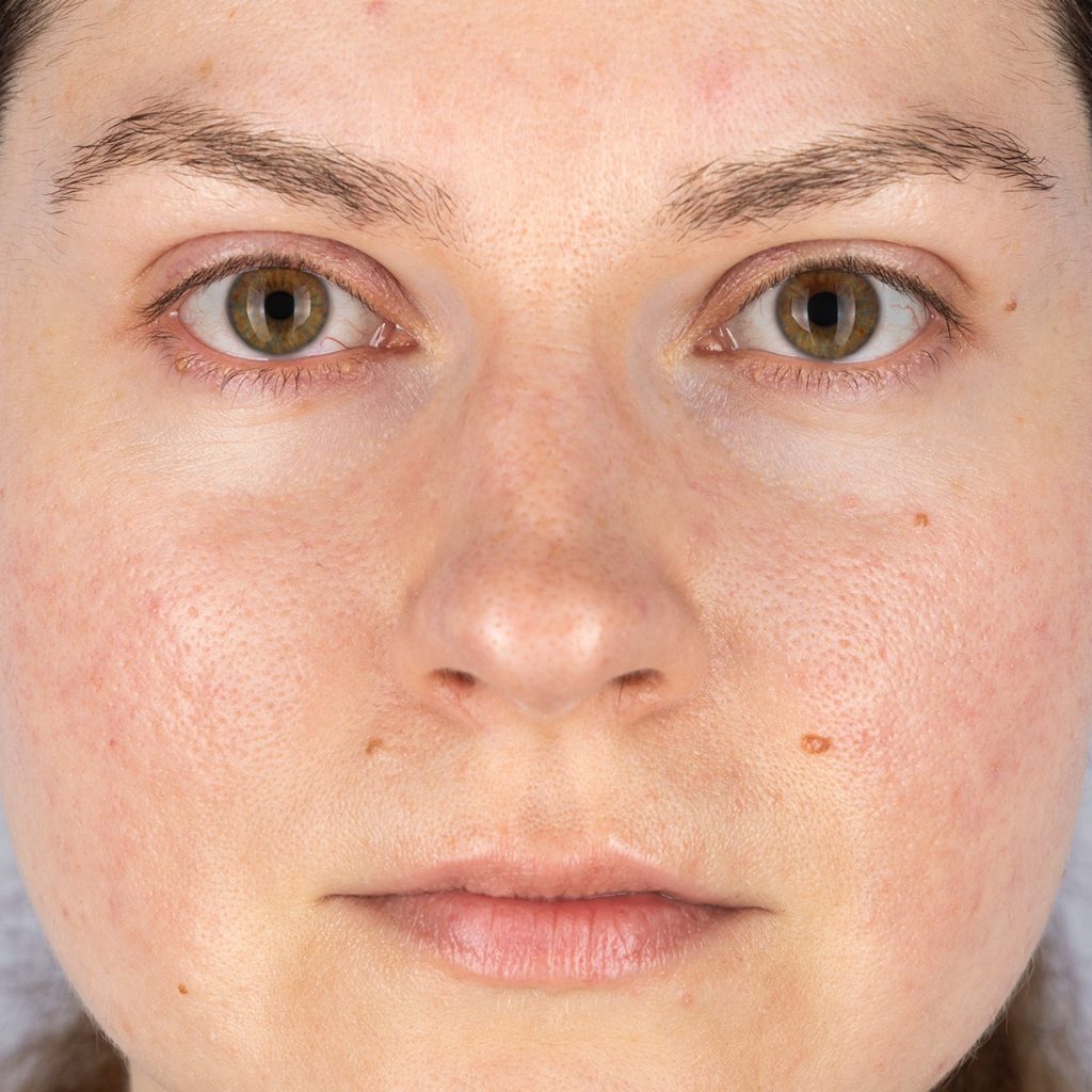 masque led après