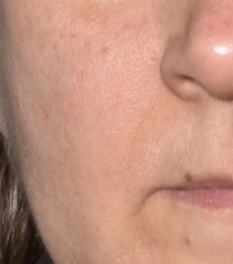 masque led après sillons