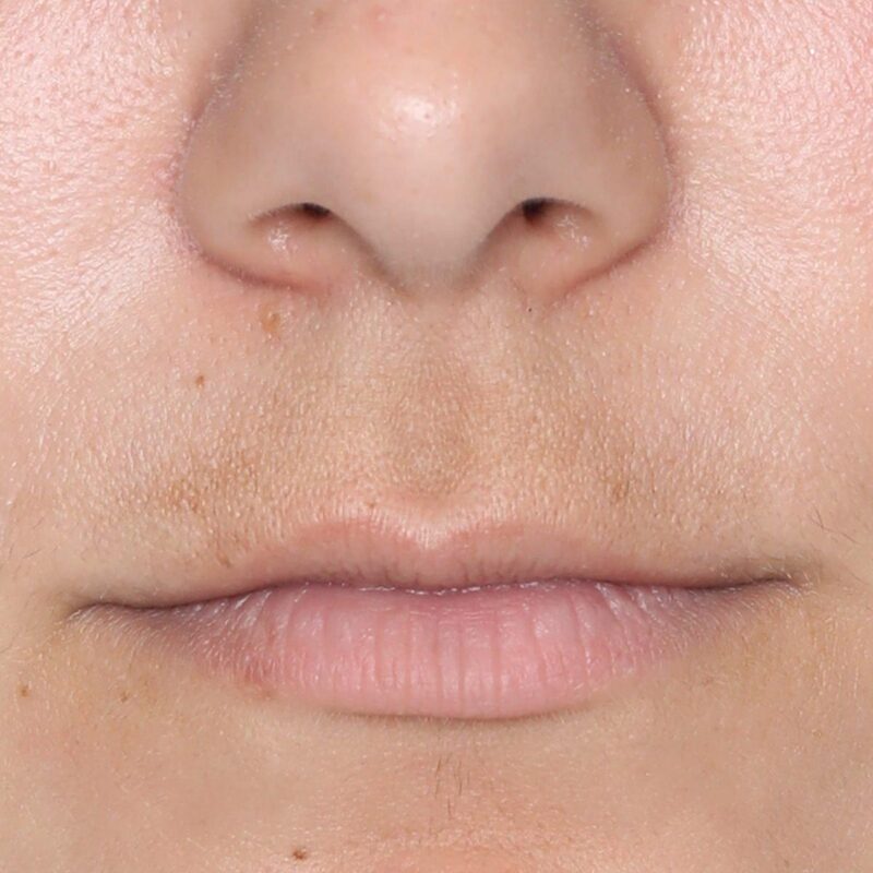 silkn masque led pores dilates coloration peau attenuee apres