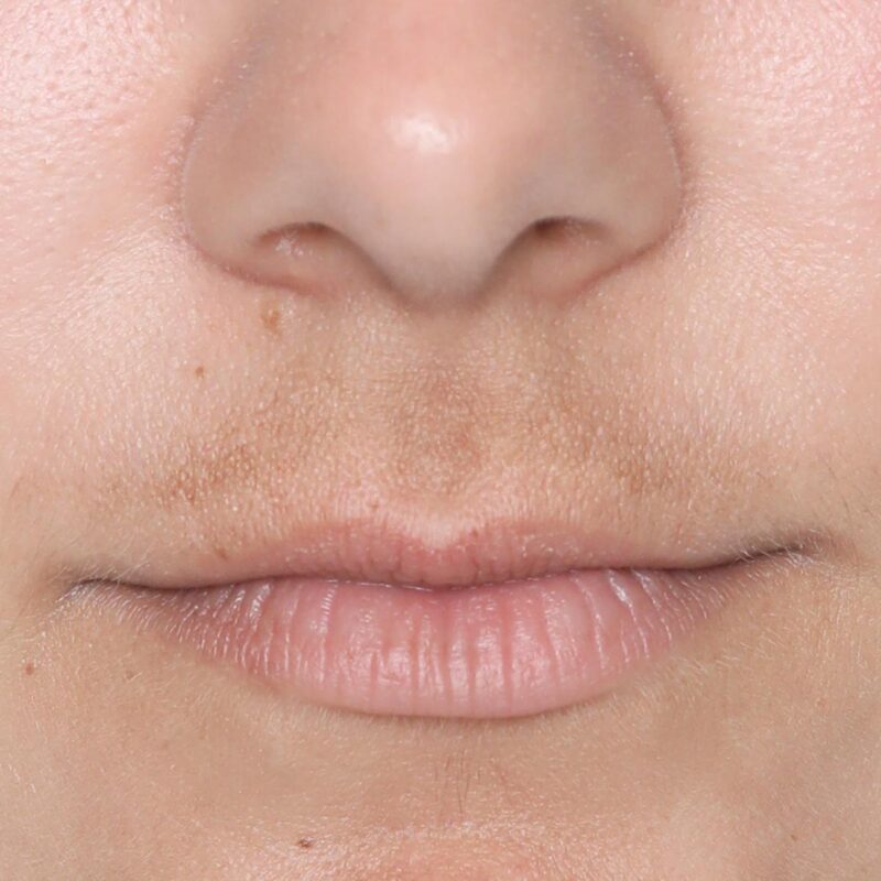 silkn masque led pores dilates coloration peau avant