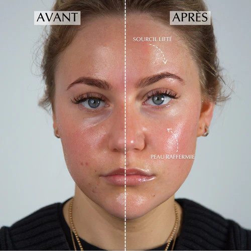 avis-ziip-halo-avant-après