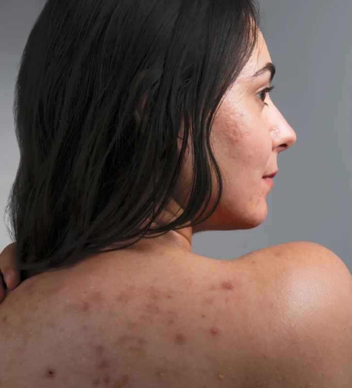 Peau acnéique sur le visage et le dos d’une femme, illustrant l’approche bienveillante de SKIN&OUT pour apaiser et rééquilibrer les peaux à imperfections