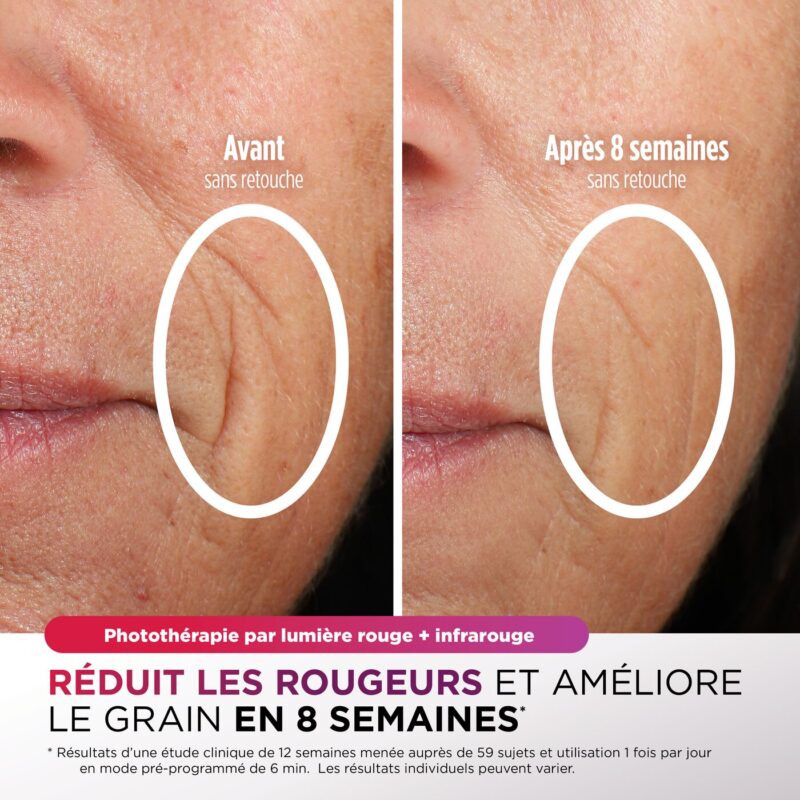 Résultats après 8 semaines d’utilisation du masque LED Shark CryoGlow – photothérapie par lumière rouge et infrarouge pour réduire les rougeurs et améliorer la texture de la peau, test et avis Totheglow.