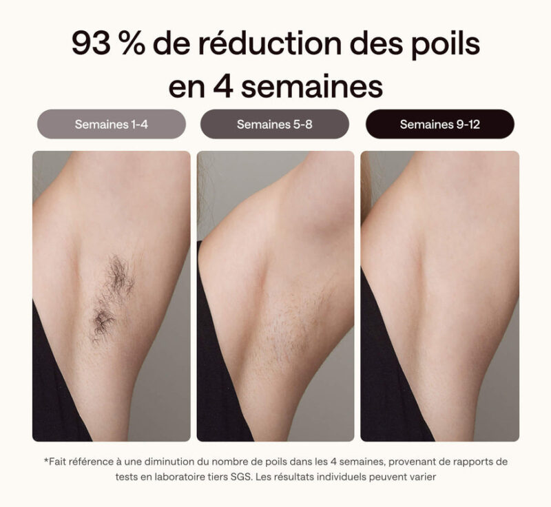 Résultats d’épilation à lumière pulsée avec le Ulike Air 3 montrant une réduction progressive des poils aux aisselles entre 4 et 12 semaines d’utilisation.