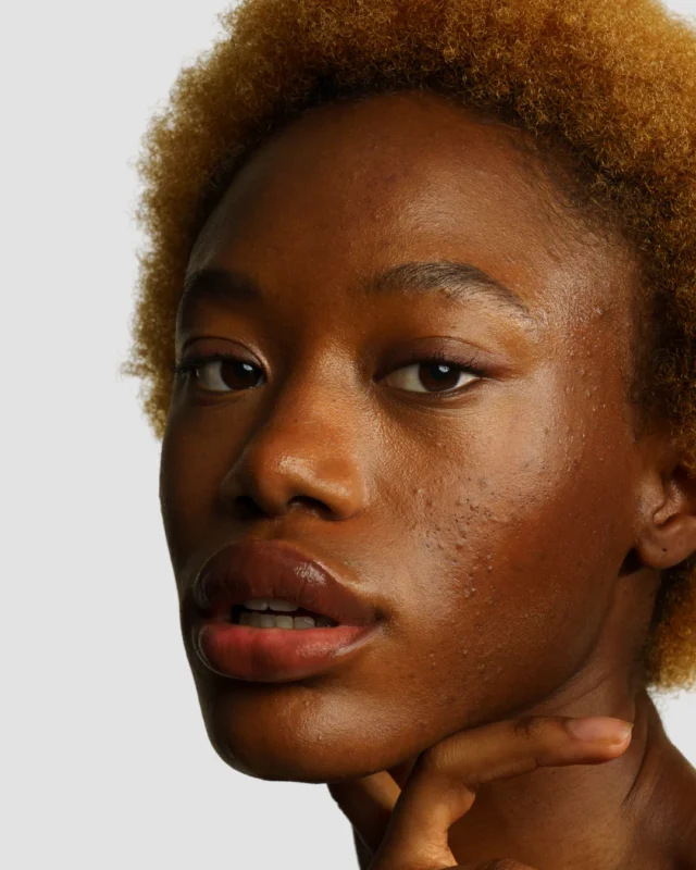 Femme avec une peau marquée par l'acnée kystique, photo de skin & out